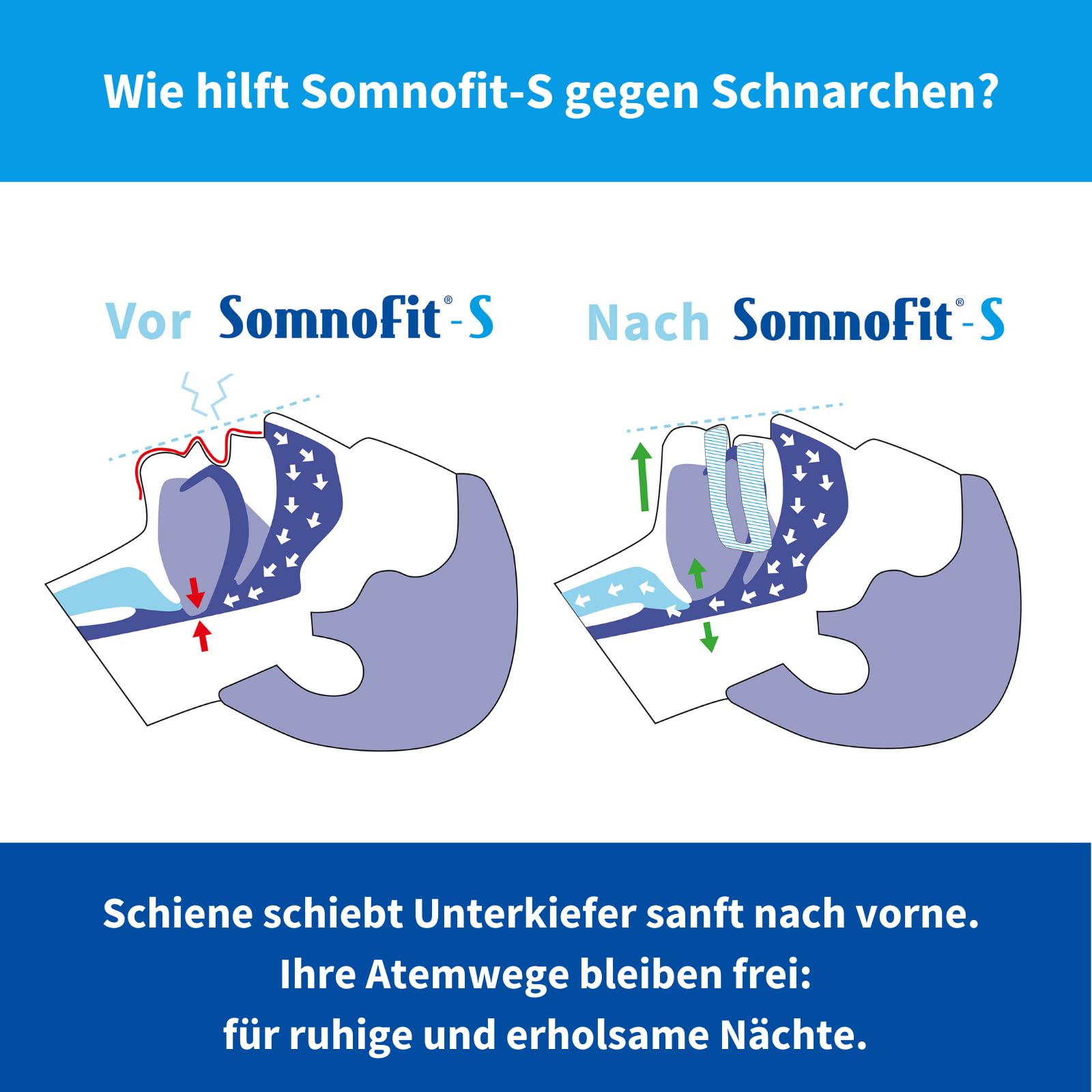 High-End Schnarchschiene SomnoFit-S – Protrusionsschiene gegen Schnarchen und Schlafapnoe – Spitzenqualität aus der Schweiz – Tschüss Sofa: Gemeinsam schlafen, energiegeladen in Alltag starten