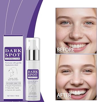 2 x Face Pigment Spot Removal Cream, 50 g Multi Glow Essence, Against Pigment Spots, Melasma and Age Spots, Anti-Sunburn Niacinamide Essence for Men and Women