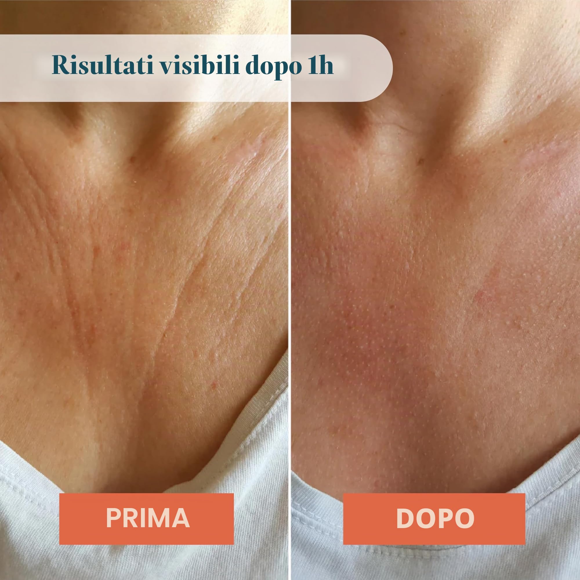 APRICOT decollete Pad antirughe in silicone medico con acido ialuronico a basso peso molecolare – Riutilizzabile fino a 30 volte, dermatologicamente confermato, vegano e senza sperimentazione su