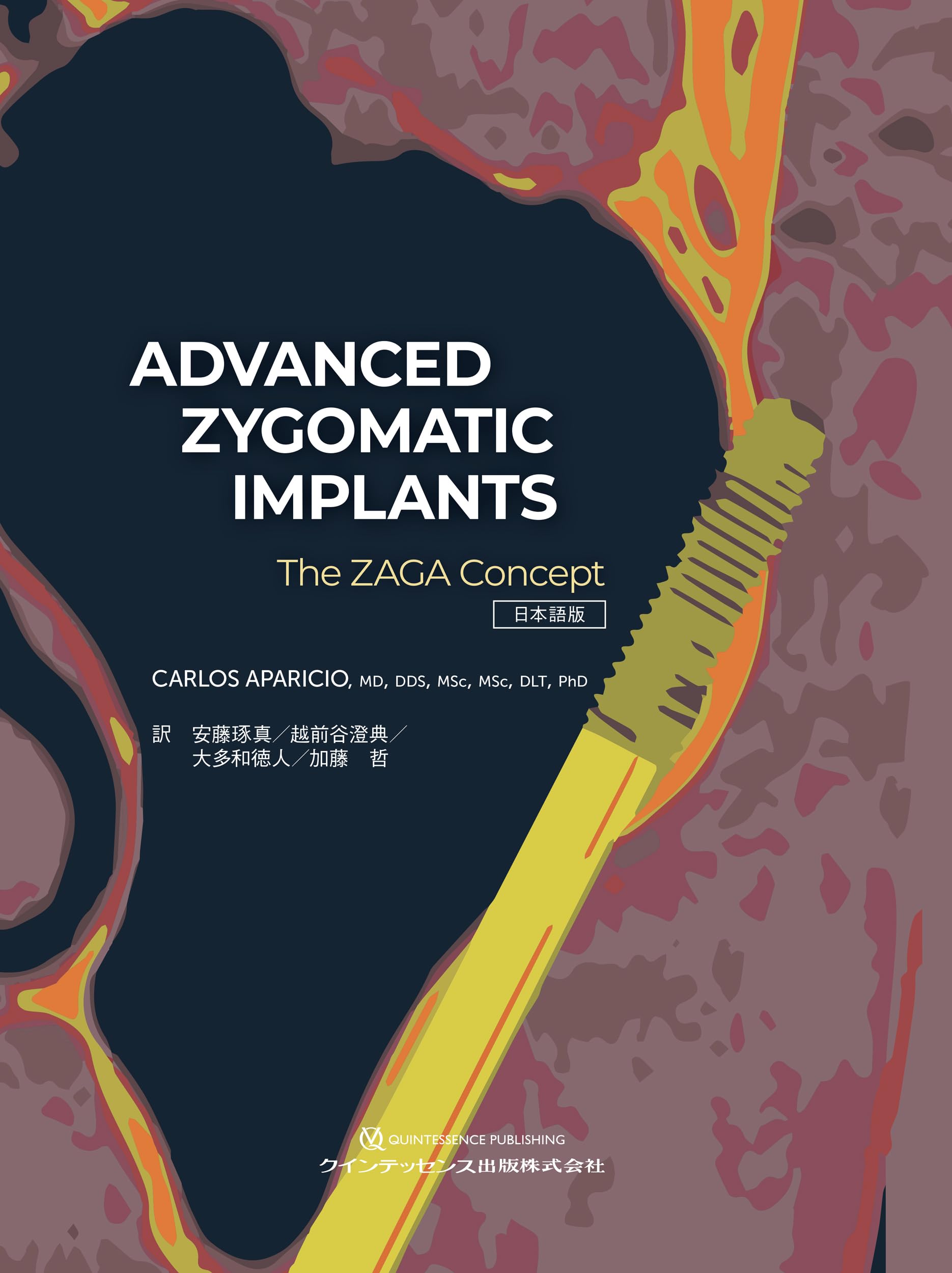 ADVANCED ZYGOMATIC IMPLANTS 日本語版: The ZAGA Concept | Carlos