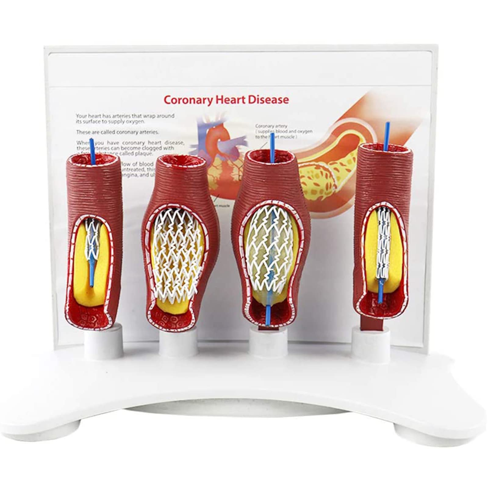 Modello di Blocco dei vasi sanguigni del Cuore e del Cervello Umano, Modello anatomico dello Stent del Corpo Umano per la dimostrazione di Modelli di Anatomia scientifica