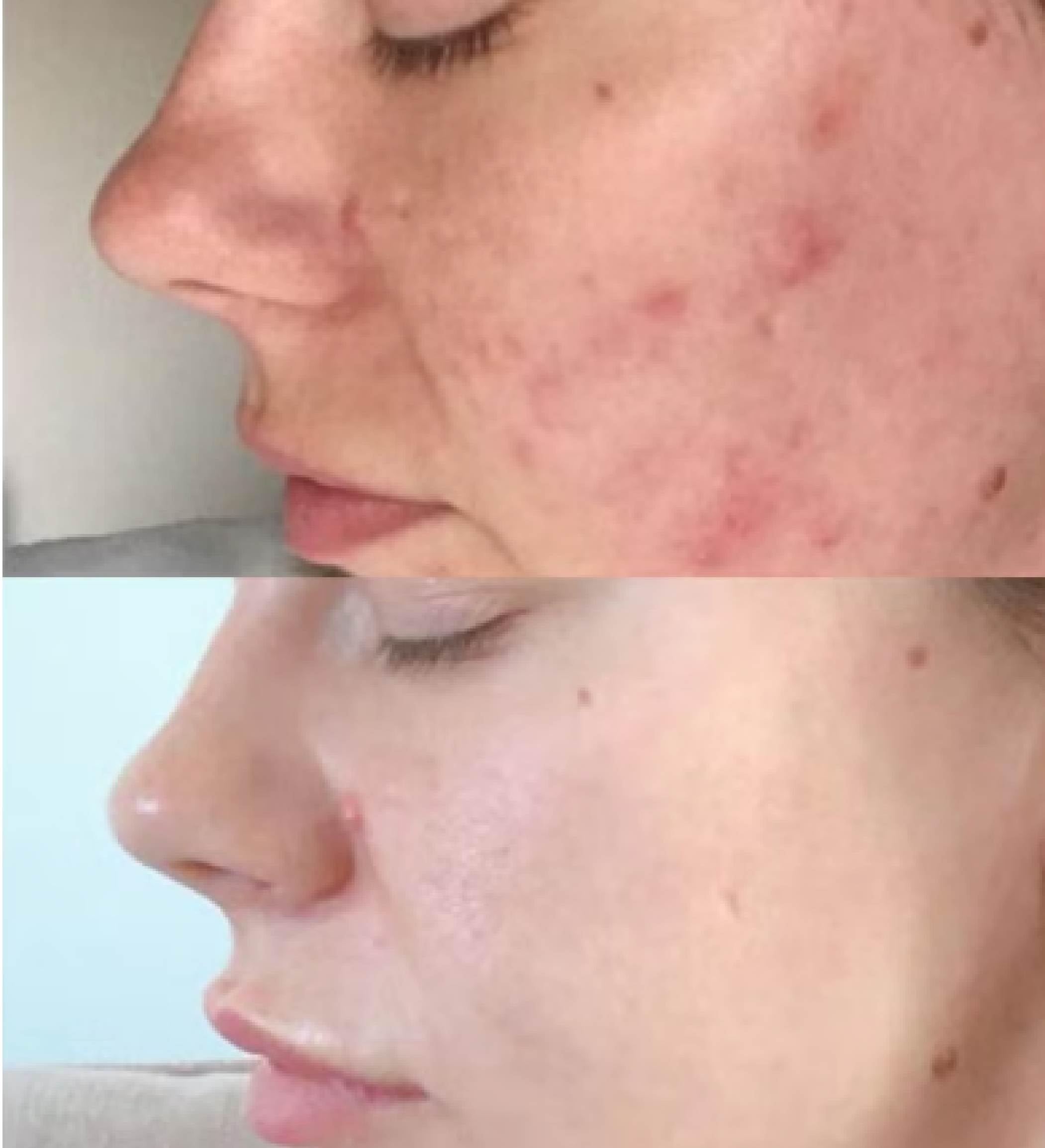 TCATherapyCare Solution Acid Peel 90% (Livello 2 pH 1.9) - Esfoliante, texture e tono della pelle - peeling viso - 30 ml con neutralizzatore (100 ml)