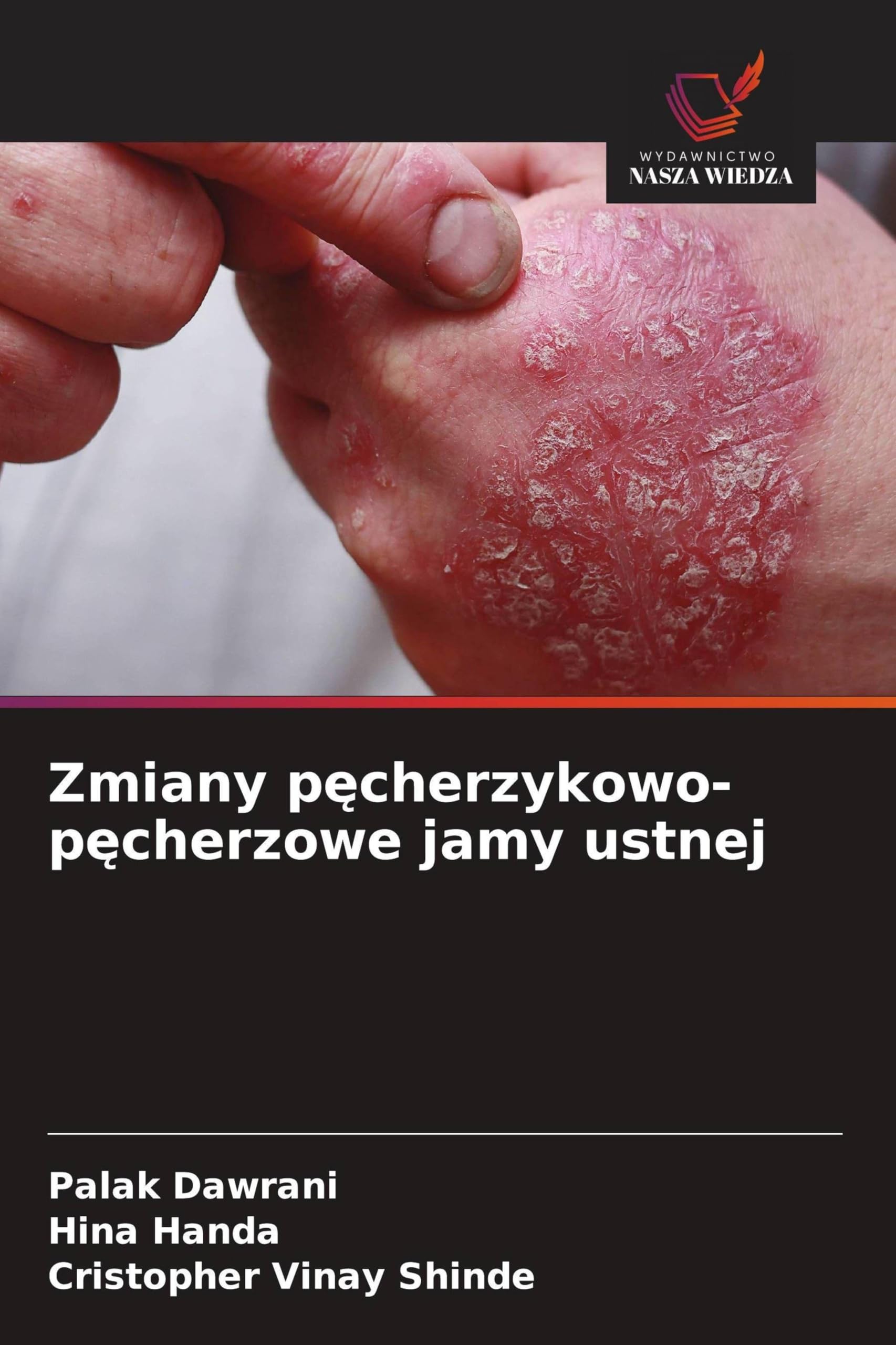 Zmiany pęcherzykowo-pęcherzowe jamy ustnej