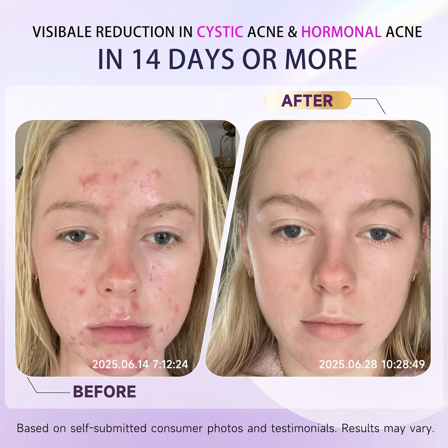 Cystic Acne Treatment for Face – Hormonal Acne Spot Treatment Pimple Cream with Azelaic Acid | Redness Reducing Acne Moisturizer for Rosacea & Sensitive, Acne-Prone Skin | Teens & Adults, 1.7 oz