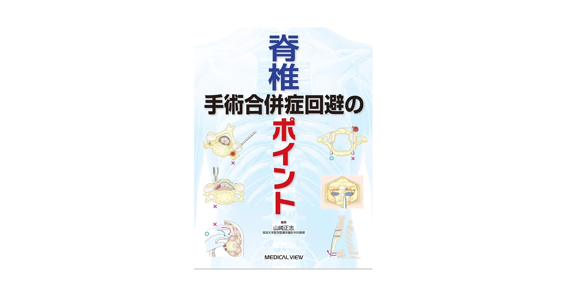 脊椎手術 合併症回避のポイント | 山崎 正志 |本 | 通販 | Amazon