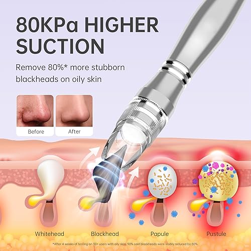 Miniatura 4 de UNOISETION Eliminadores de puntos negros, 2 en 1 de grado profesional en el hogar, limpiador de poros para puntos negros, puntos blancos,