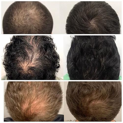 Miniatura 2 de MKKENLEY El mejor juego de champú y acondicionador de jengibre antipérdida de cabello tratamiento de pérdida de cabello para hombres mujeres