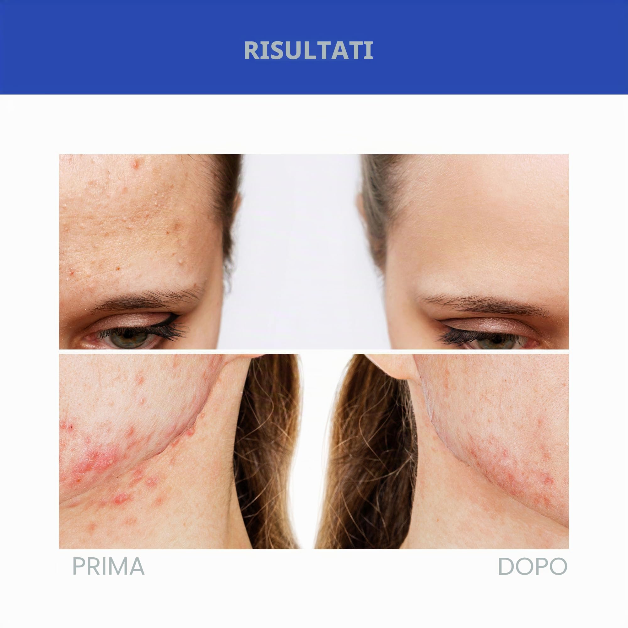 Foreo Espada 2, Terapia a Luce LED, Dispositivo di Skincare Anti-Acne a Luce Pulsata- Silicone Medico, Trattamento Viso per Cicatrici, per Brufoli e Macchie Viso, Approvato dalla FDA, Cobalt Blue