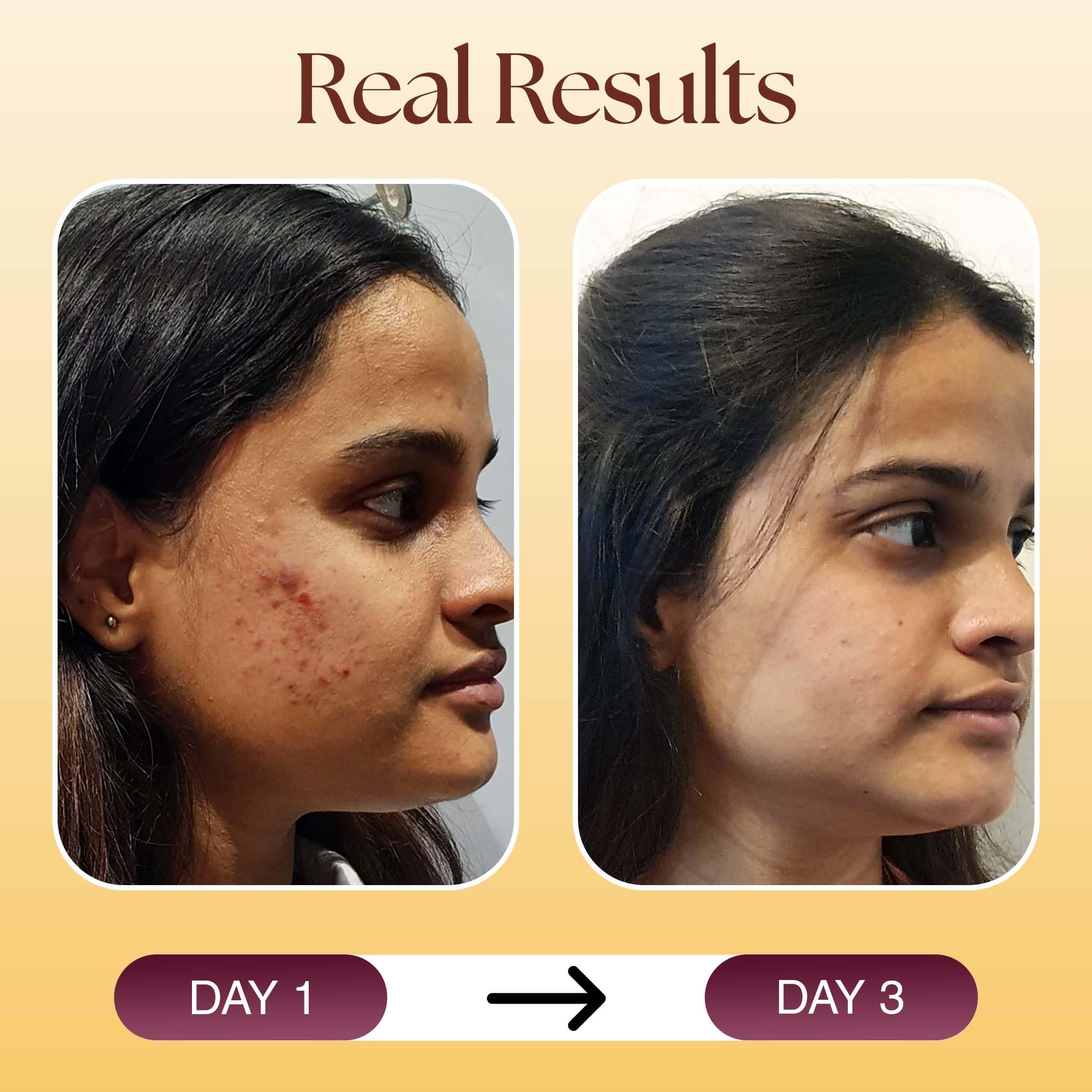 Siya Ayurveda Acne Spot Corrector Gel For Reducing Active Acne |1% Niacinamide and 2% Salicylic Acid Reduces Pimples, Blackheads, & Whiteheads 4