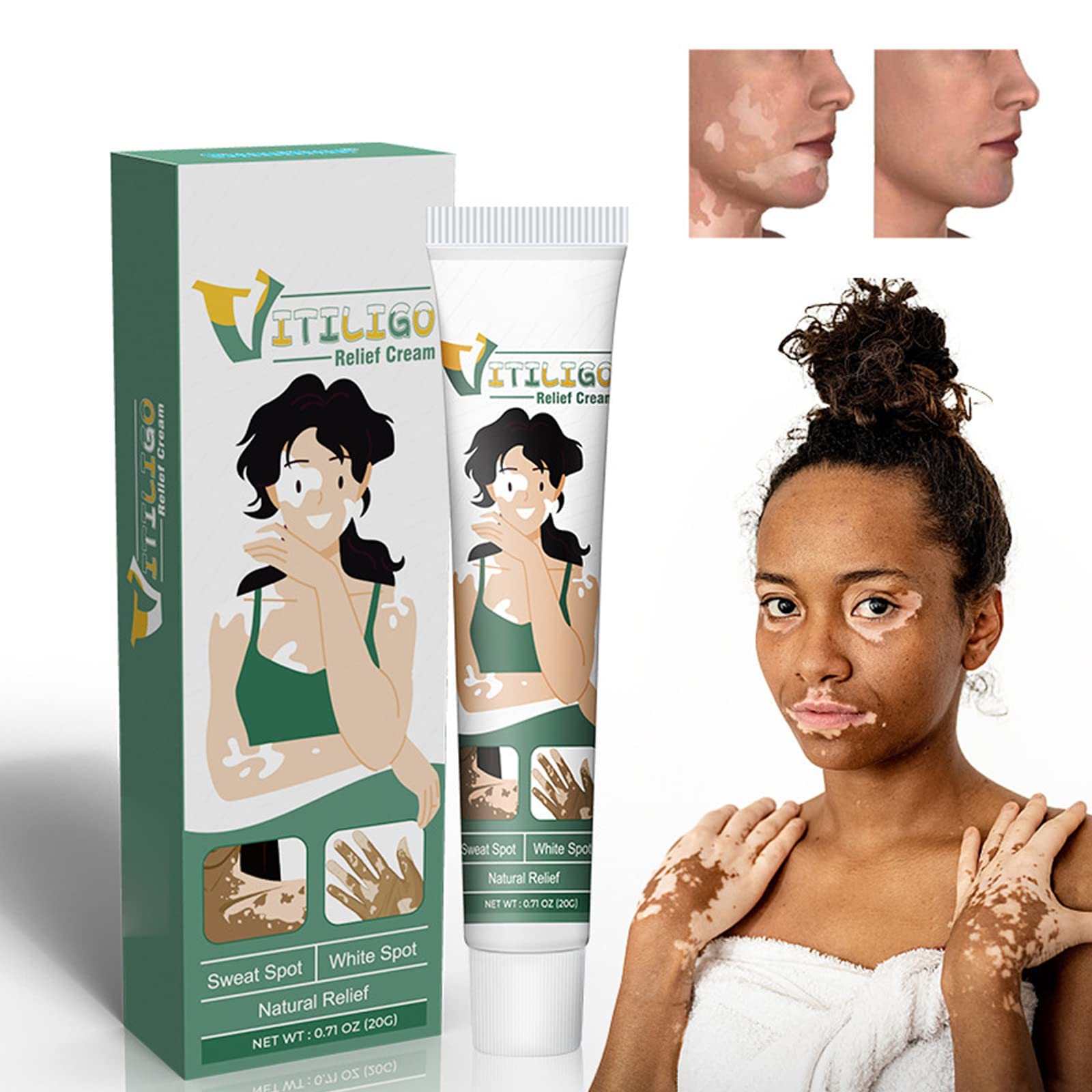 Buy Shinyme Vitiligo Skin Repair Cream, Vitiligo Cream, Vitiligo Care