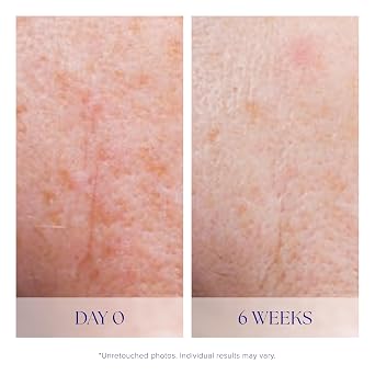 iS CLINICAL Active Serum - Helps visibly even skin tone, Excellent for acne-prone skin, Anti-Aging, Face Serum