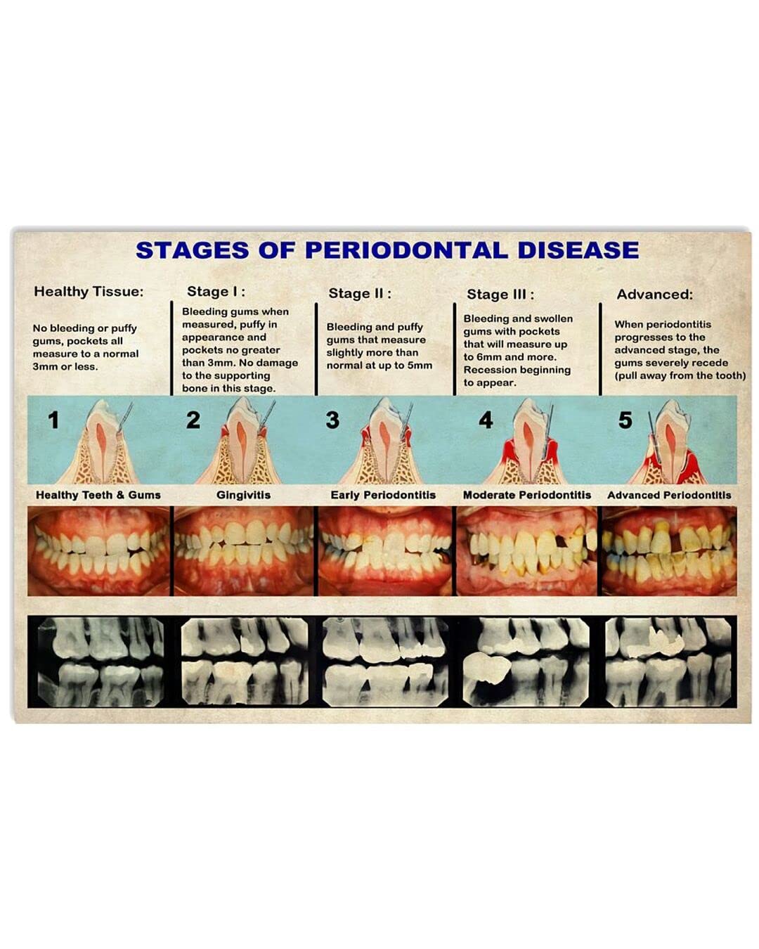 Periodontal Disease Progression Chart