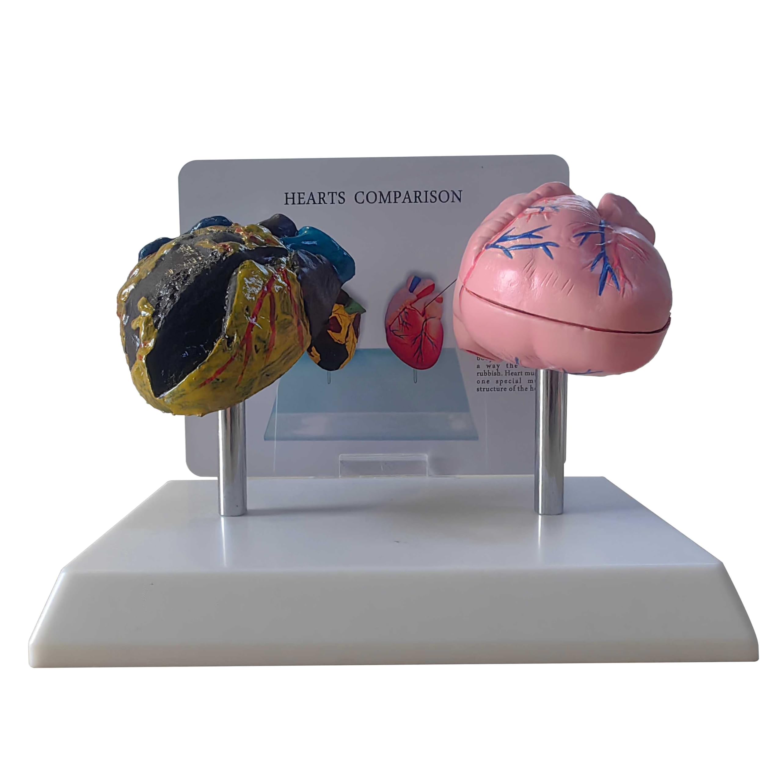 Kdjfs Smokers Heart Model + Healthy Heart Model Life Size Human Heart Anatomy Model With Pathological Features And Accurate Anatomy Structure For Emonstrate The Effects Of Smoking On Heart Health
