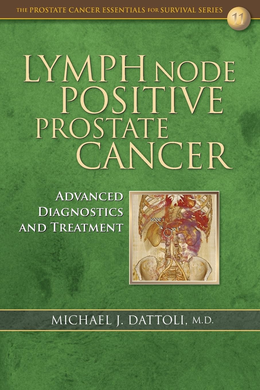Lymph Node Positive Prostate Cancer: Advanced Diagnostics and Treatment