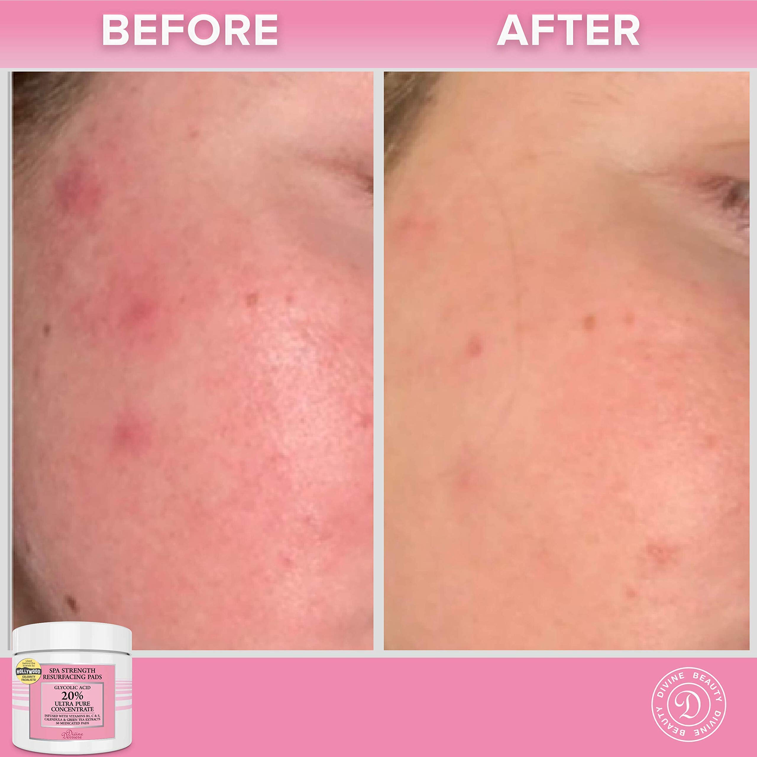 Buy Anti Aging Skin Care Set Glycolic Acid Peel 40 & Glycolic