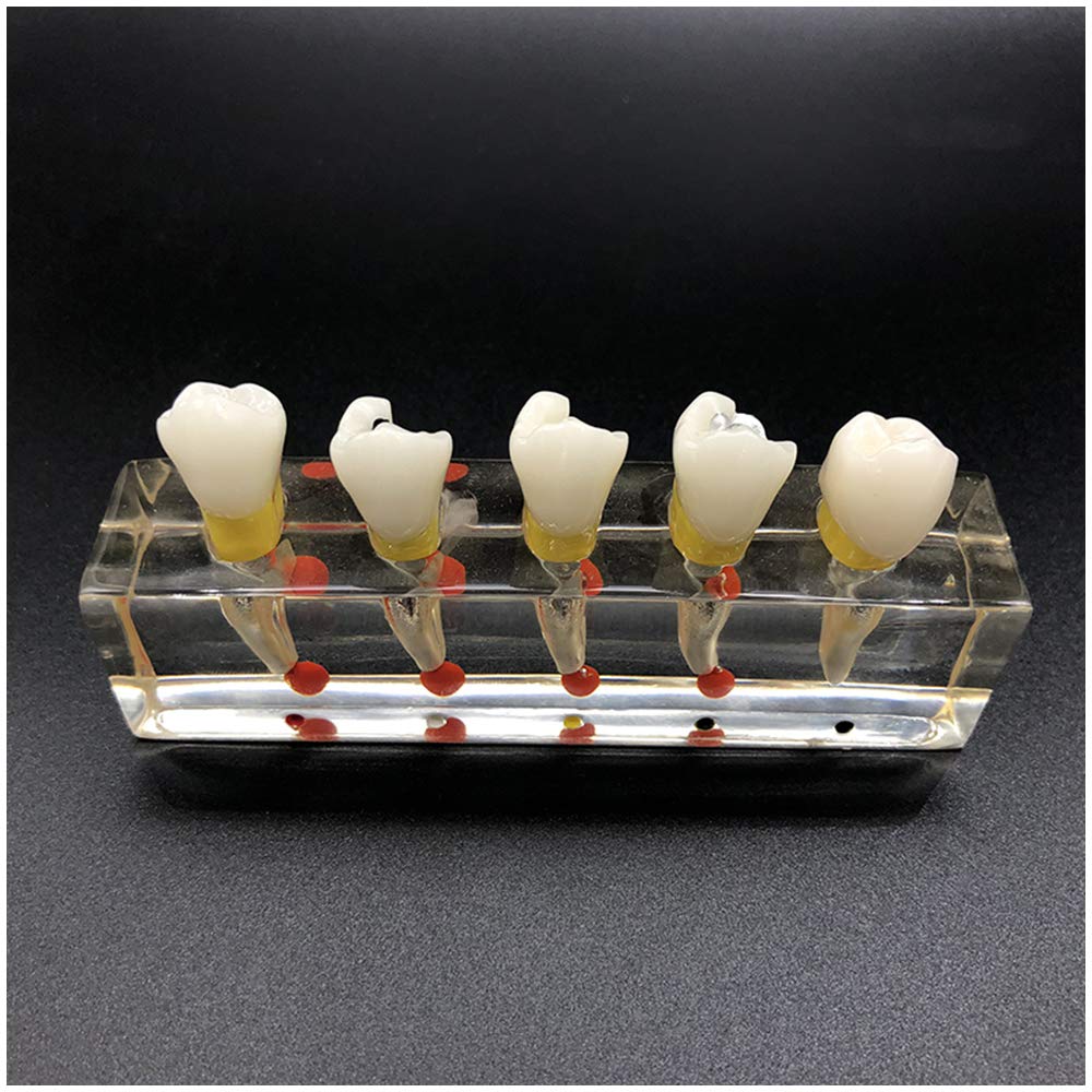 Dentaire 5 étapes endodontique Modèle Traitement - Étude des Dents dentaires Modèle d'enseignement - Caries de Dents prémolaires Modèle - Dents endodontique Restauration Modèle,A
