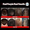 Gorro Láser para Crecimiento Capilar - Terapia de Luz Roja Aprobada por la FDA para la Regeneración del Cabello - Tratamiento Efectivo para Cabello Adelgazado y Alopecia en Hombres y Mujeres 1 Onza (Paquete de 1) 3