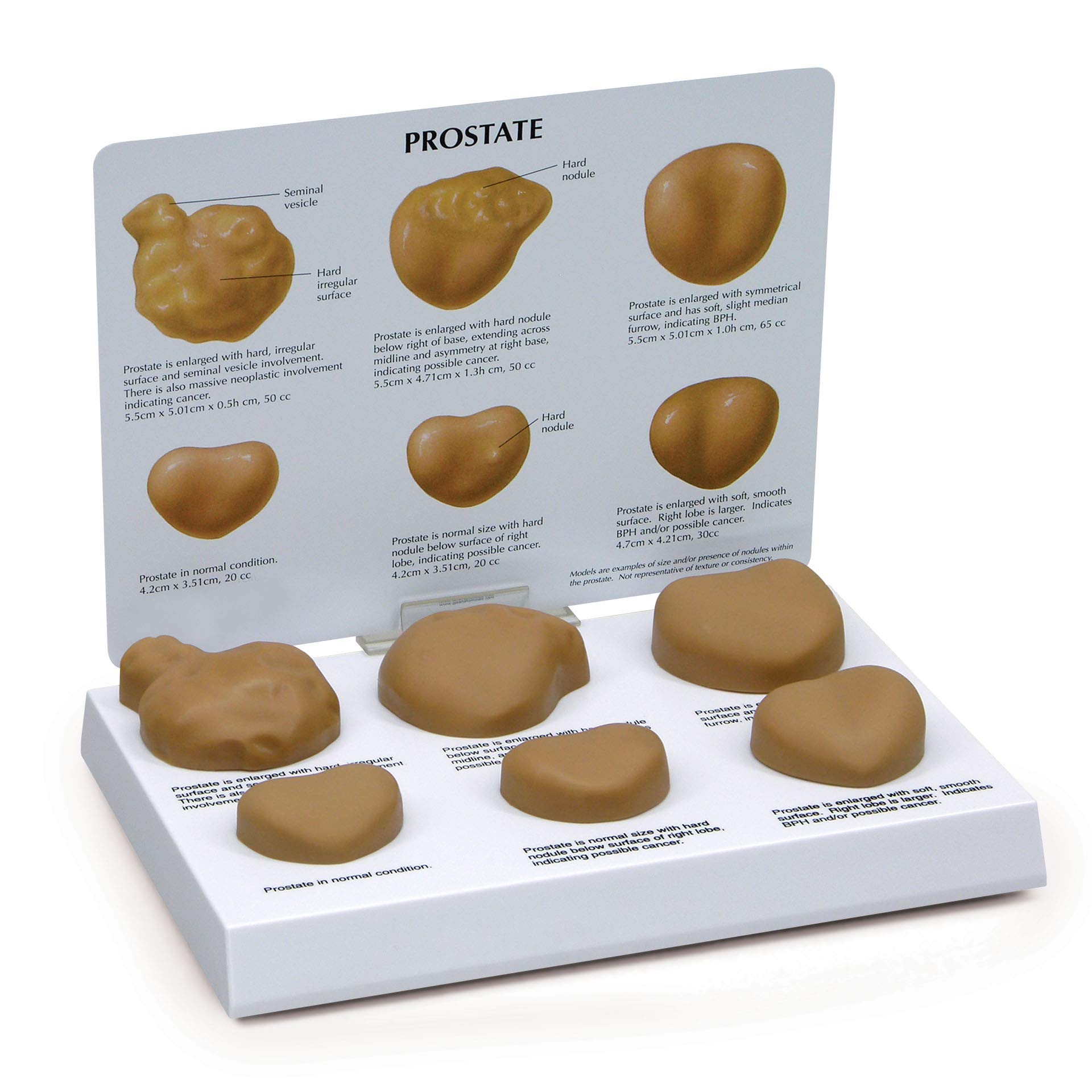 Buy GPI AnatomicalsProstate Model Set, Replica with Pathologies for ...