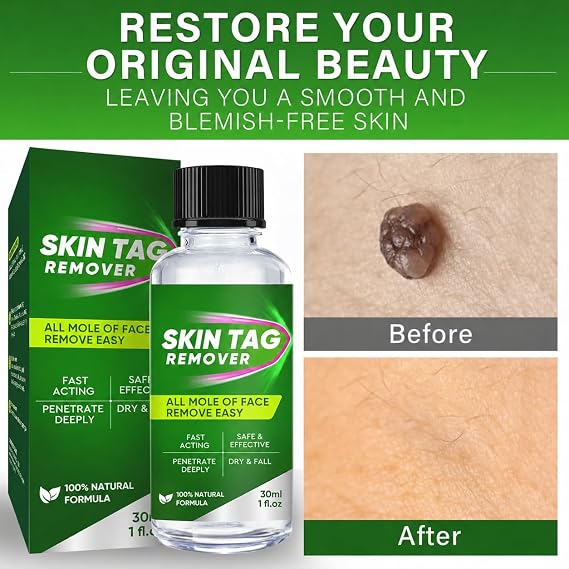 Skin Tag Removal Kit, Fast-Acting Wart Remover