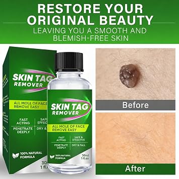 Skin Tag Removal Kit, Fast-Acting Wart Remover