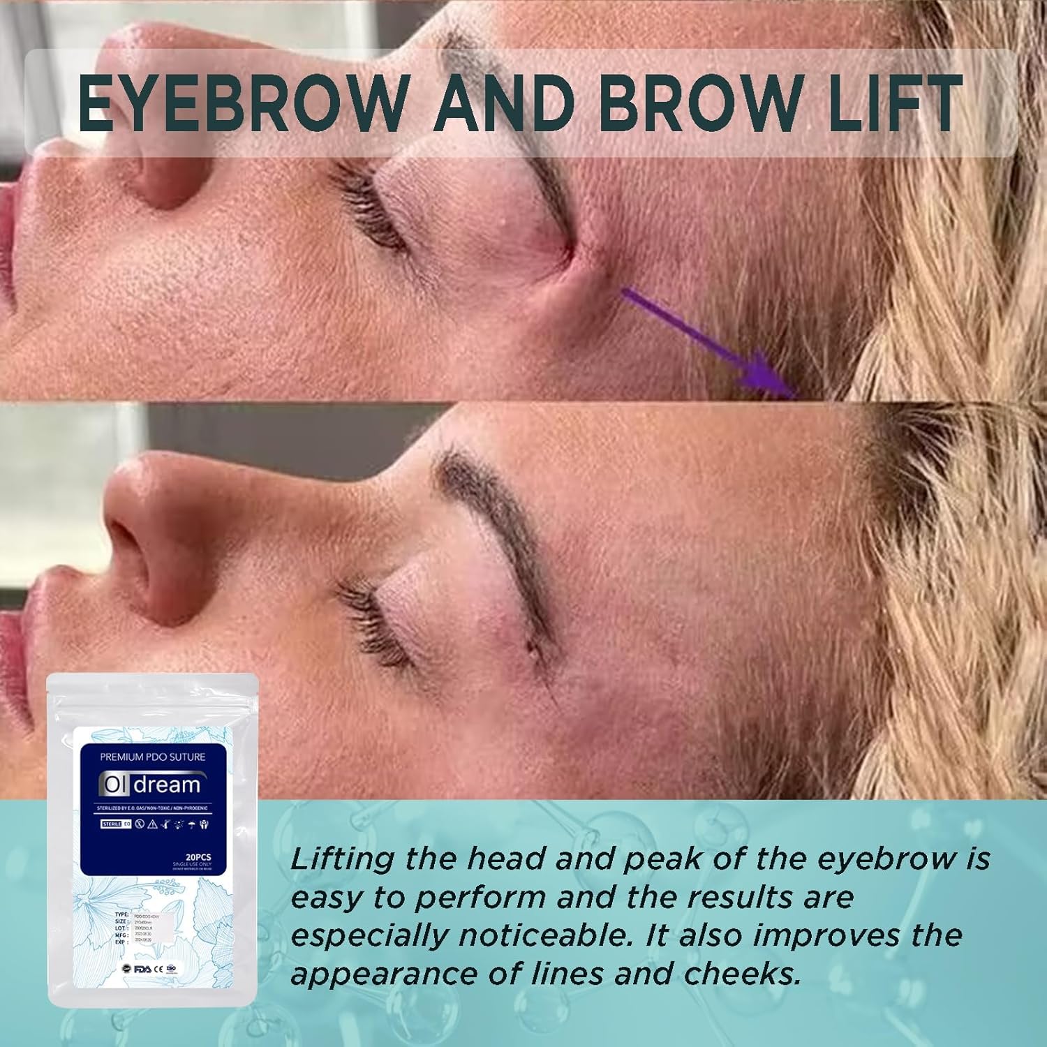Oldream Pdo-Zahnfäden 21G60mm, Pdo-Zahnfäden für Fox-Eye-Lifting, Pdo-Fäden für Facelifting-Zahnfäden 20 Stück