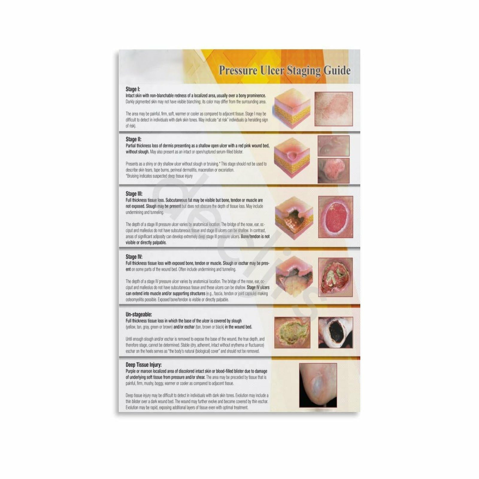 Npuap Pressure Ulcer Staging Guide —The Pressure Ulcer Scale For