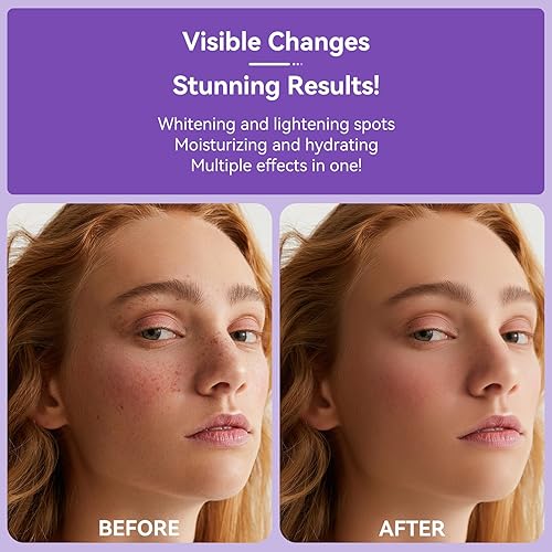 Miniatura 4 de Removedor de manchas oscuras para cara, cuerpo y manos, corrector de manchas oscuras para manchas solares de melasma, removedor de manchas marrones