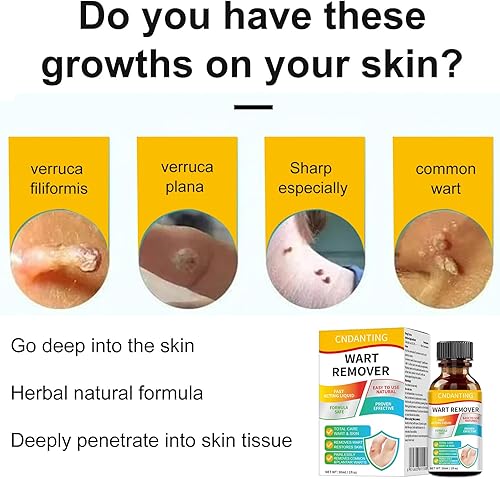 Miniatura 3 de CNDANTING Eliminador profesional de verrugas y maíz con 17% de ácido salicílico, fórmula de congelación para verrugas plantares, comunes y planas en