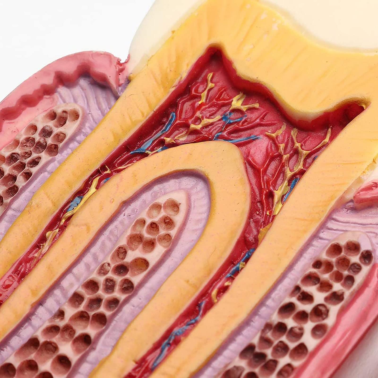 Modello di Dente con Carie Dentale, Modello di Denti Malati, Modello di Studio per pazienti odontoiatrici, Modello di Studio per confronto di Carie 6 Volte, Strumenti didattici