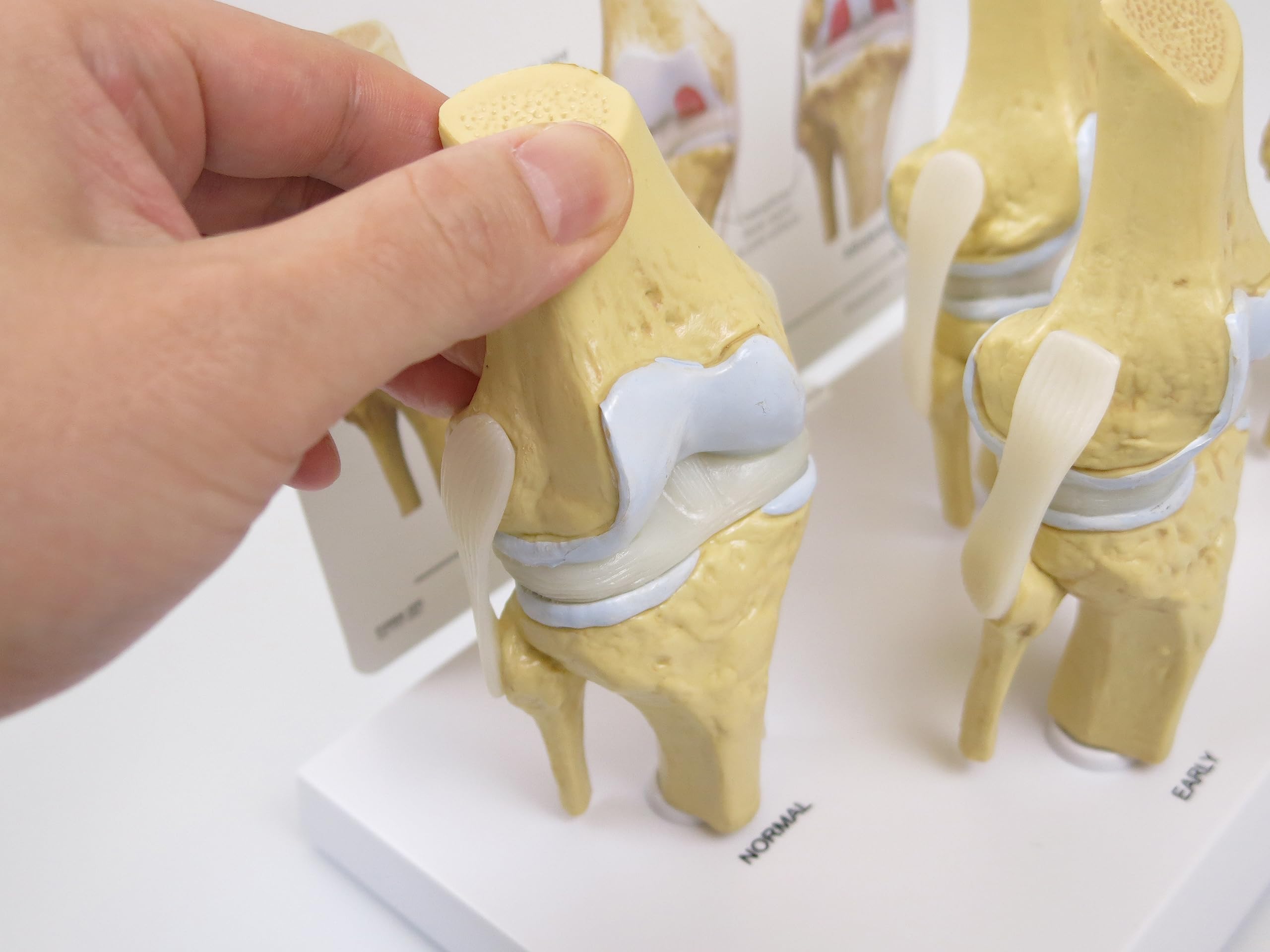 GPI Anatomicals 1100 Osteo-Kniemodellset 4 verschiedener Stadien
