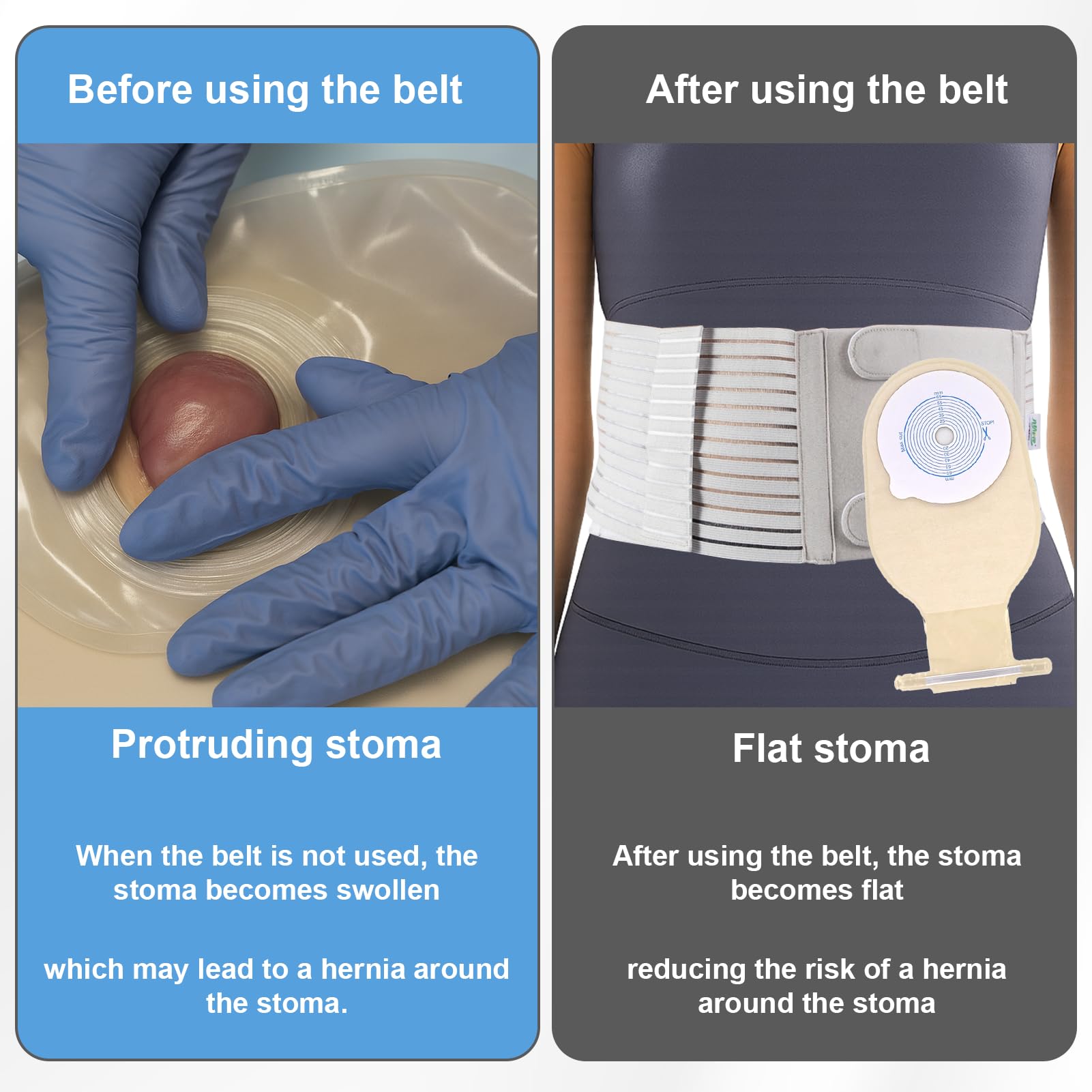 Cintura per stomia addominale, comoda cintura per colostomia, cintura di supporto per stomia regolabile, cintura portatile per ileostomia, cintura per colostomia, fascia per stomia addominale, cintura