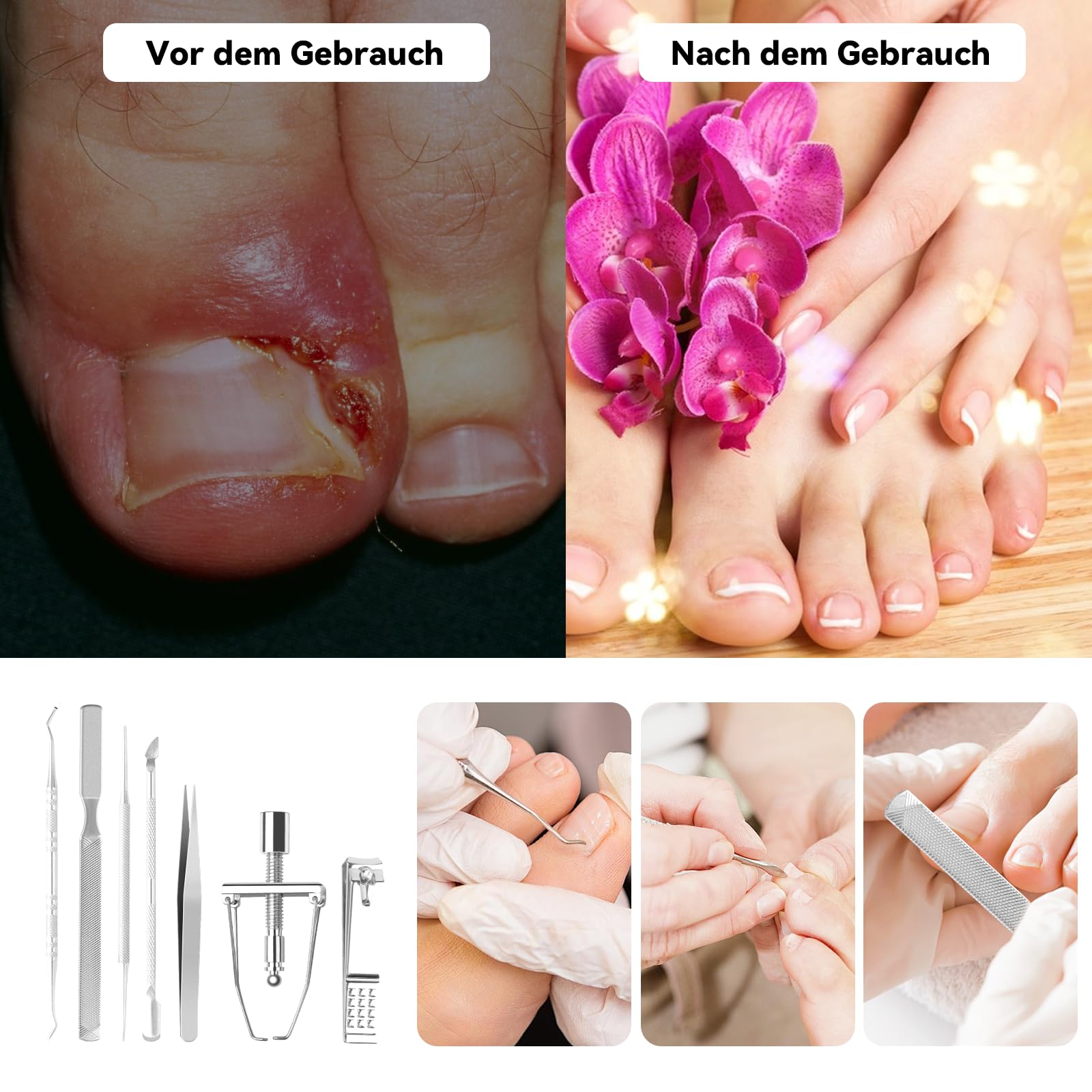 112 Stck Eingewachsene Zehenngel Werkzeug, Das multifunktional  Eingewachsene Zehenngel Set, Nagelspange Fungel, Nagelpilz Pflaster,  Manikre, Pedikre, fr Damen und Mnner : Amazon.de: Kosmetik