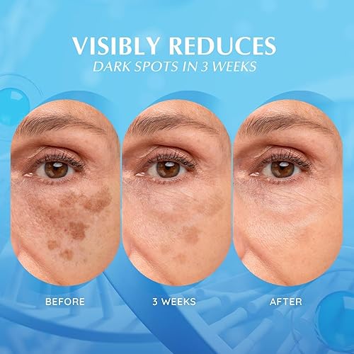 Miniatura 3 de EnaSkin Eliminador de manchas oscuras para la cara tratamiento corporal de hiperpigmentación para pecas