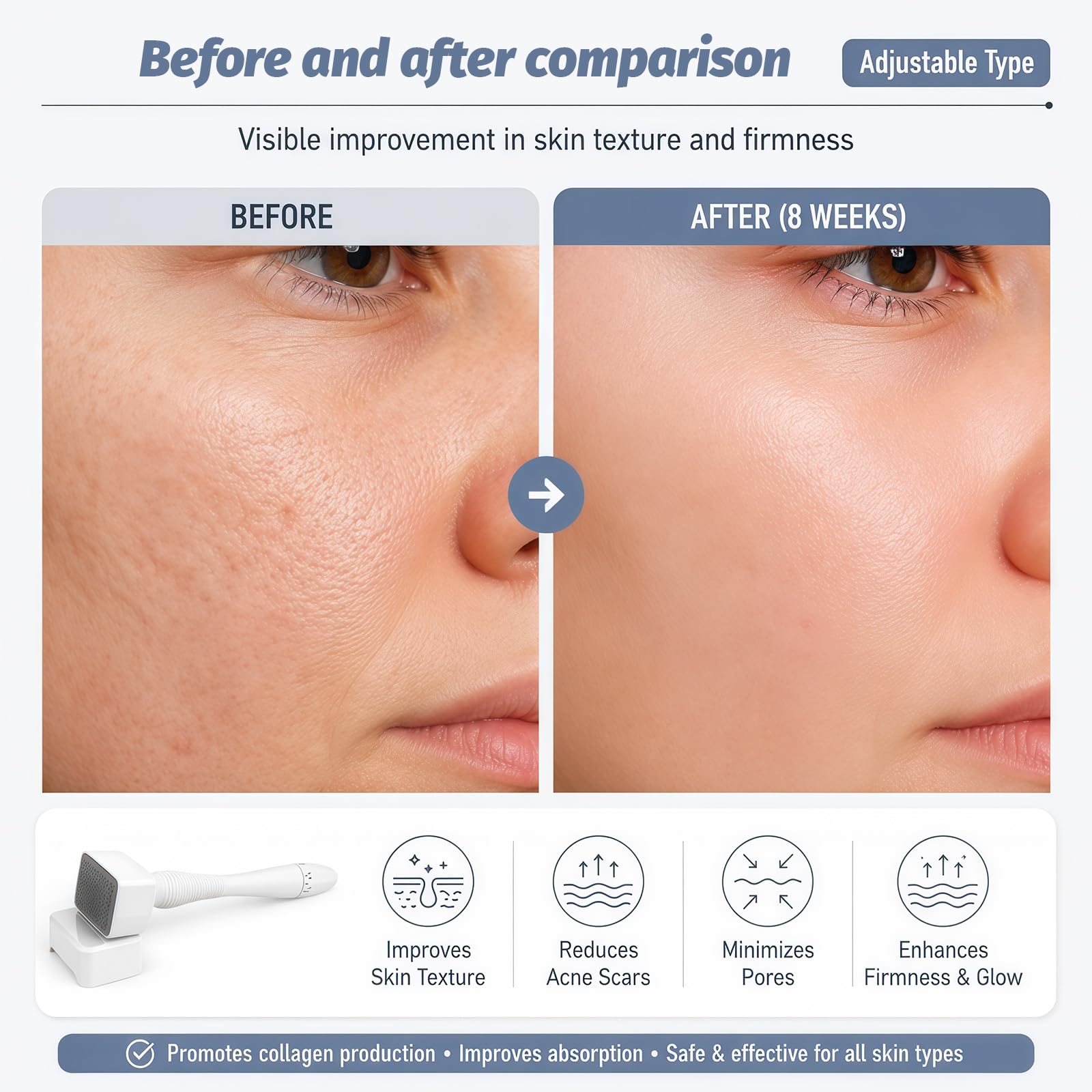 Tampon Microneedling, Stylo Réglable avec 140 Aiguilles en Titane pour la Stimulation et l’Amélioration de la Peau,Pour Cheveux, Barbe, Réduction des Rides et Cicatrices, Portable