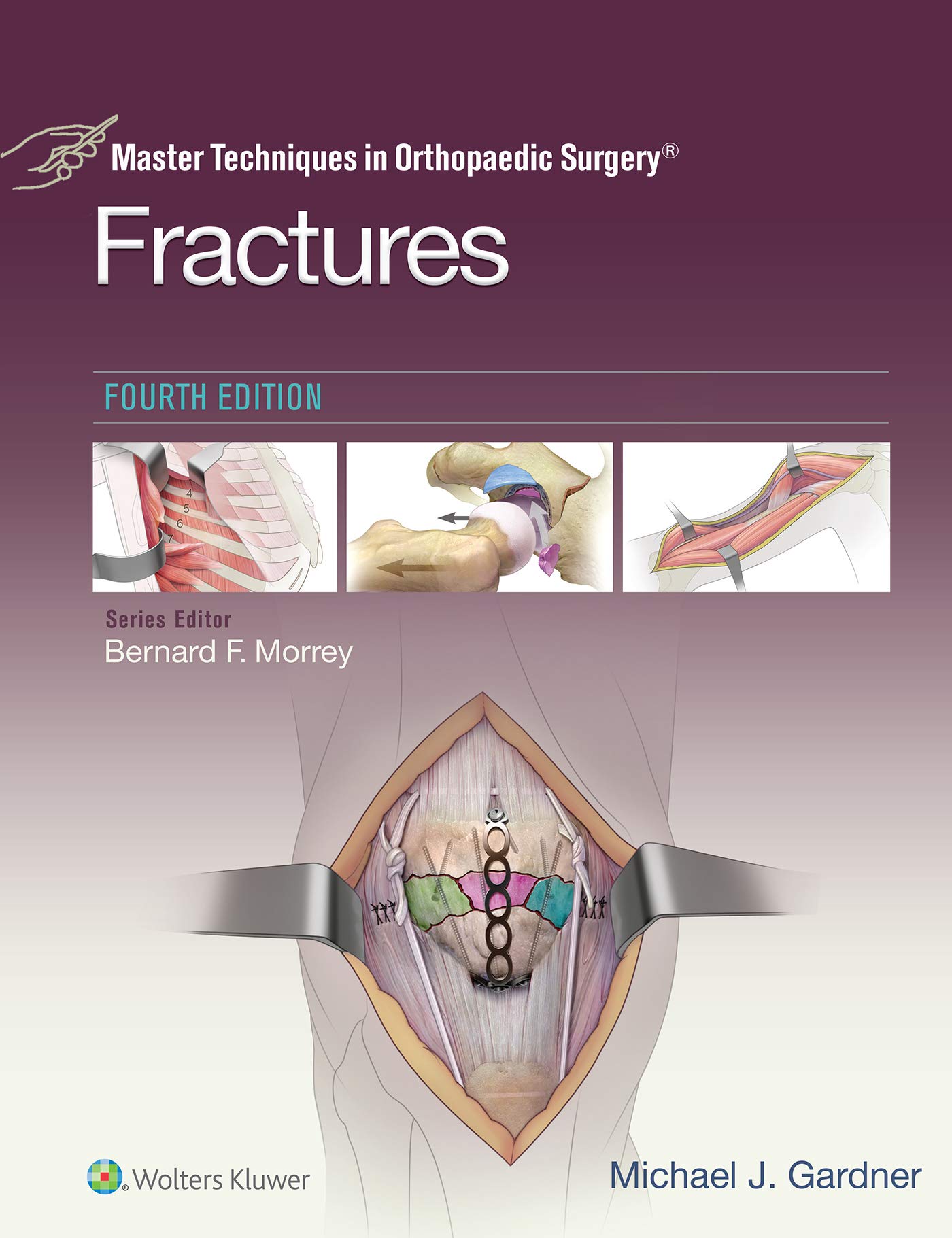Master Techniques in Orthopaedic Surgery: Fractures (English Edition)