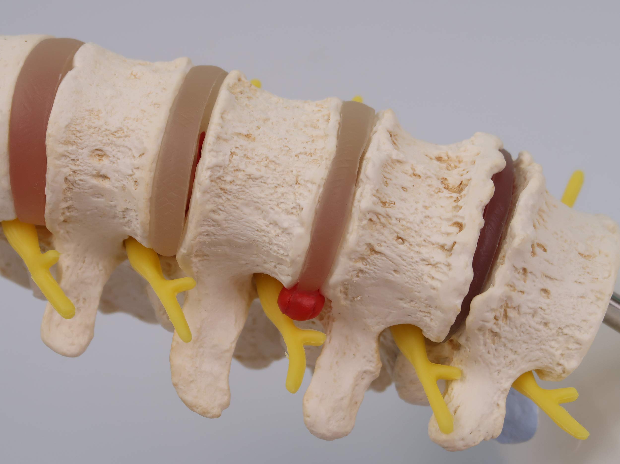 3B Scientific A795 Stadi dell'Ernia del Disco Intervertebrale e Degenerazione della Vertebra + software gratuito di anatomia - 3B Smart Anatomy