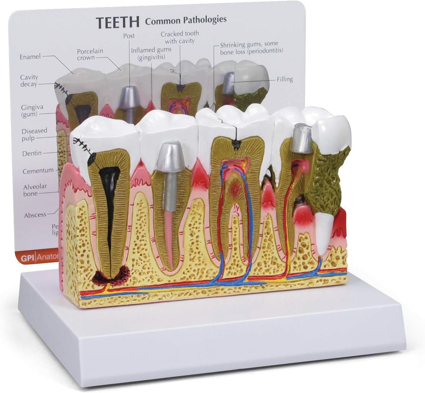 GPI Anatomicals Human Teeth Anatomy Model with Common Dental Problems