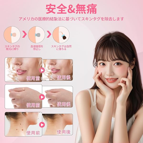 FERNIDA イボ取りフルセット イボ除去キット 88 回分バンド付 4 サイズ対応 全身ケア 片手操作 1 年超長持ち 日本語取扱説明書付 - 2