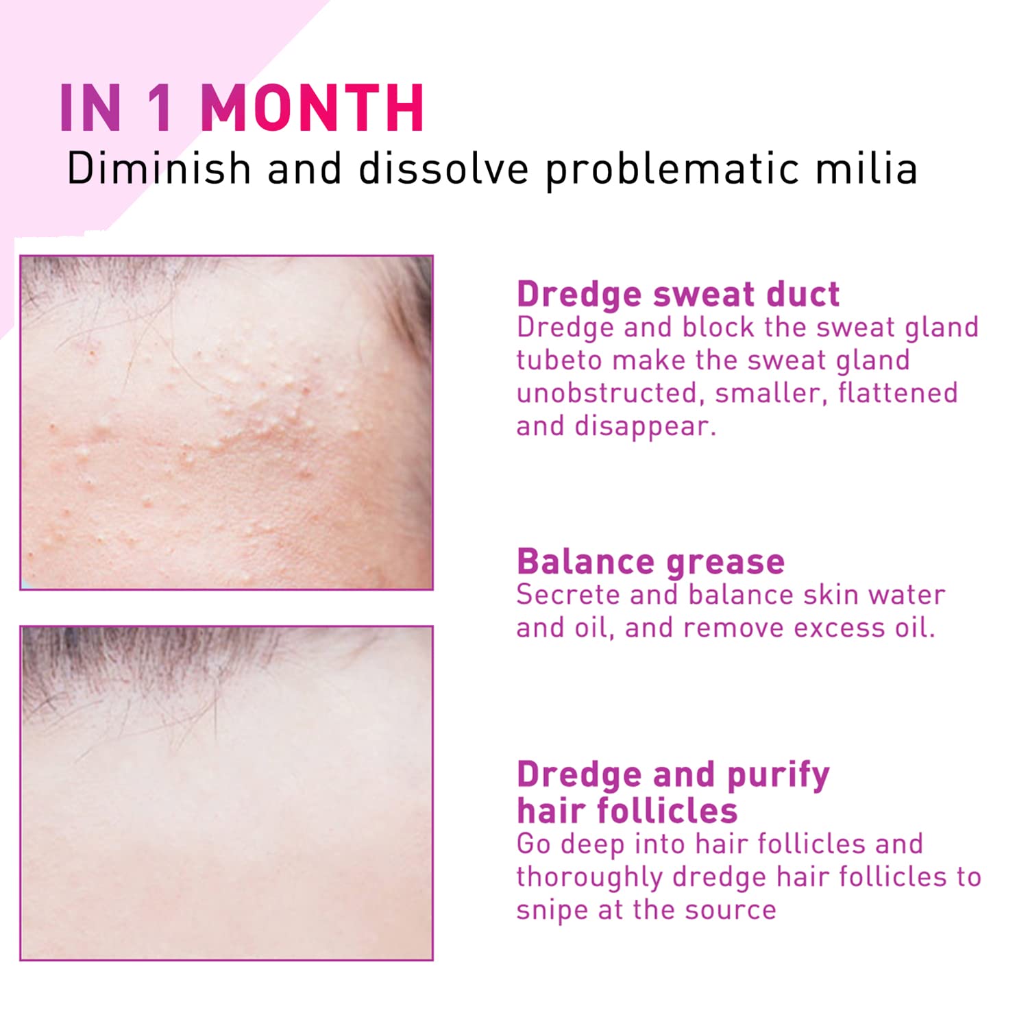 شراءمصل الوجه لعلاج Milia ، Milia Remover Spot يساعد على إذابة وتقليل