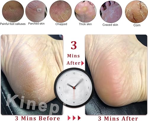 Miniatura 4 de Kinepi Quitador de callos para pies y exfoliante de pies, piedra pómez para quitar la piel dura del maíz, piel muerta para uso en kit de raspador de
