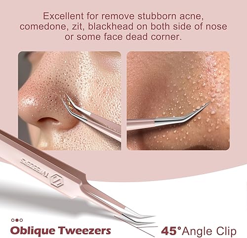 Miniatura 4 de WSYUB Pinzas profesionales para eliminar puntos negros, extractor de acné, kit de herramientas para reventar espinillas, clip para puntos blancos,