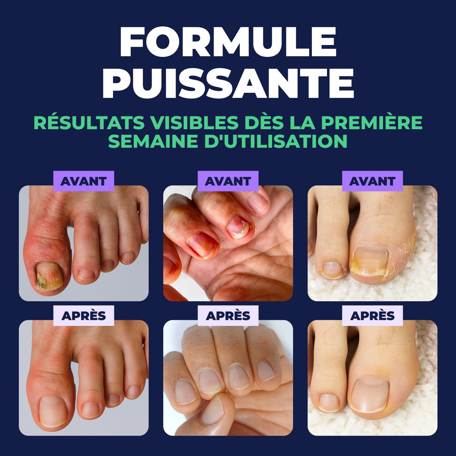 Orivelle Stylo de Soin Cosmétique pour Ongles, Stylo Embellisseur d'Ongles à l'Huile d'Arbre à Thé, Pour Ongles des Mains et des Pieds, Lot de 2