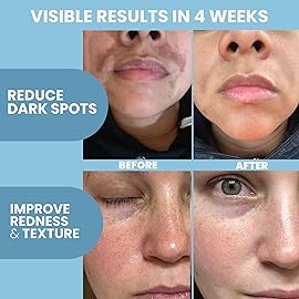 Eva Naturals Azelaic Acid Serum for Face - Niacinamide, Hyaluronic Acid, Vitamins A+C+E - Redness Relief, Dark Spots, Uneven Skin Tone, Texture, Pores, Topical Booster for Clearer, Smoother Skin, 2oz