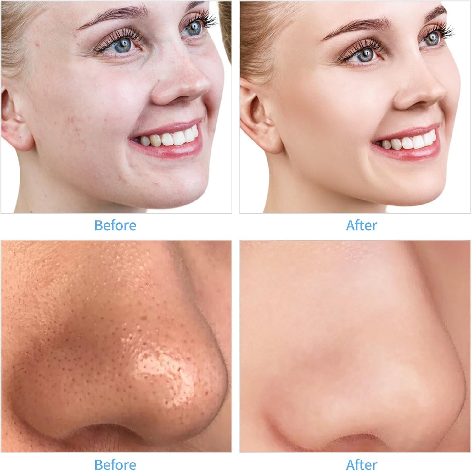 Appareil De Microdermabrasion Diamant Professionnel | Appareil Portable à Cristaux Pour Le Soin Du Visage, Kit D'élimination Des Points Noirs