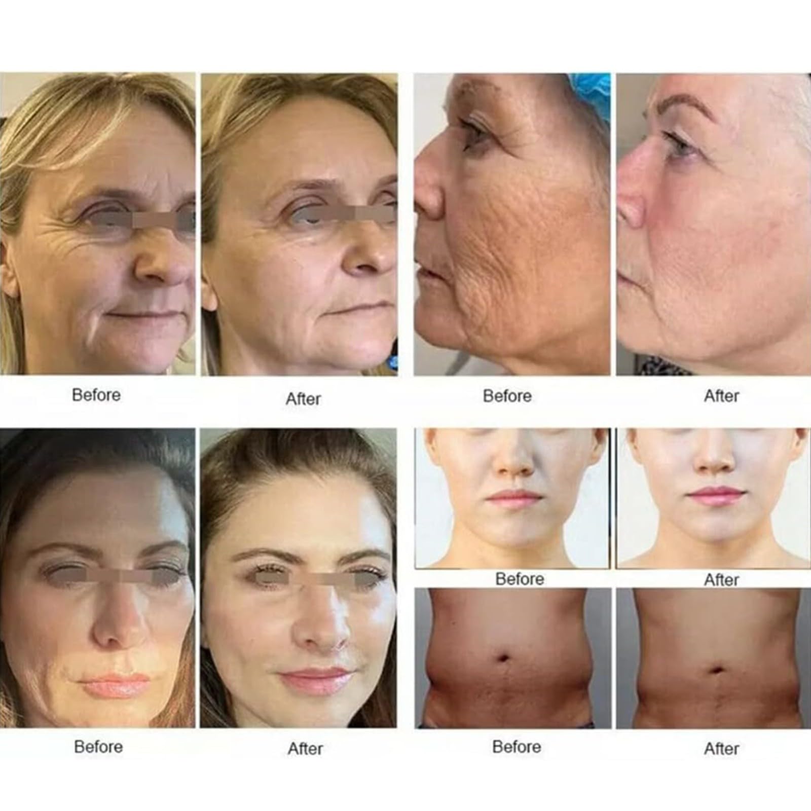 7D Hi-FU Gesichtslifting- Und Vaginalstraffungsmaschine, Gesichtslifting, Fettreduzierung, Hautverjüngung, Schönheitsausrüstung, 9 Patronen