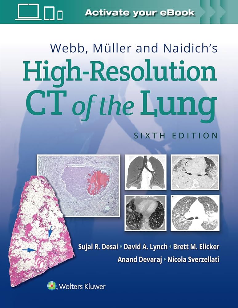 High-Resolution CT of the Lung 第5版 High-Resolution CT of the Lung: 9780781769099: Medicine & Health