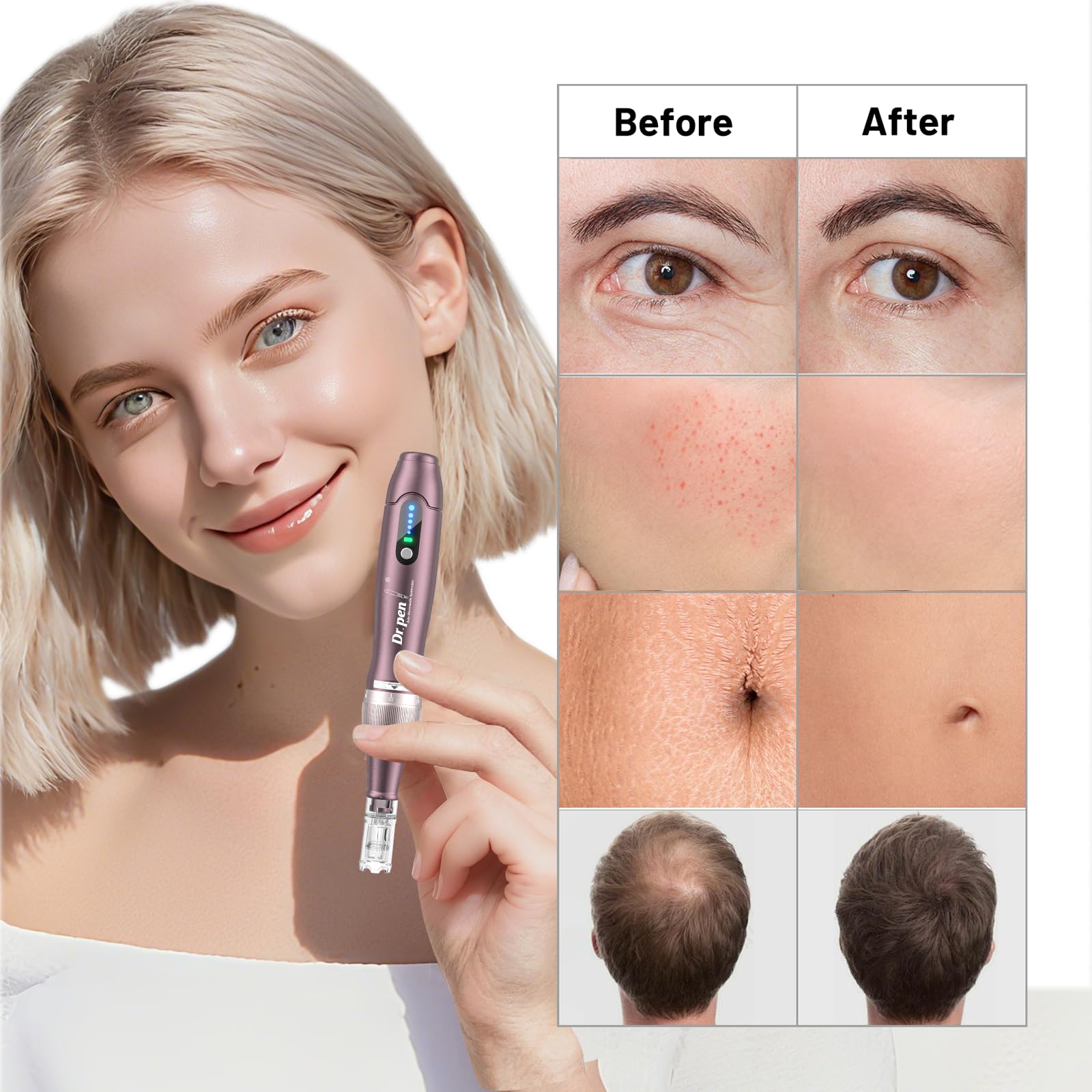 Dr. Pen 2026 Ultima A10 Professioneller Microneedling Pen, Kabellos mit 25 Ersatzkartuschen, 5 Stufen und LED-Anzeige Elektrischer Dermapen für Haarwachstum, Gesicht, Körper und Hautpflege