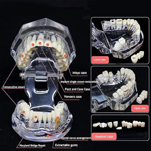 Miniatura 4 de Reparación neural Modelo dental Enfermedad del implante Modelo de dientes Dentista Estándar Patológico Dientes removibles Modelo de enseñanza para