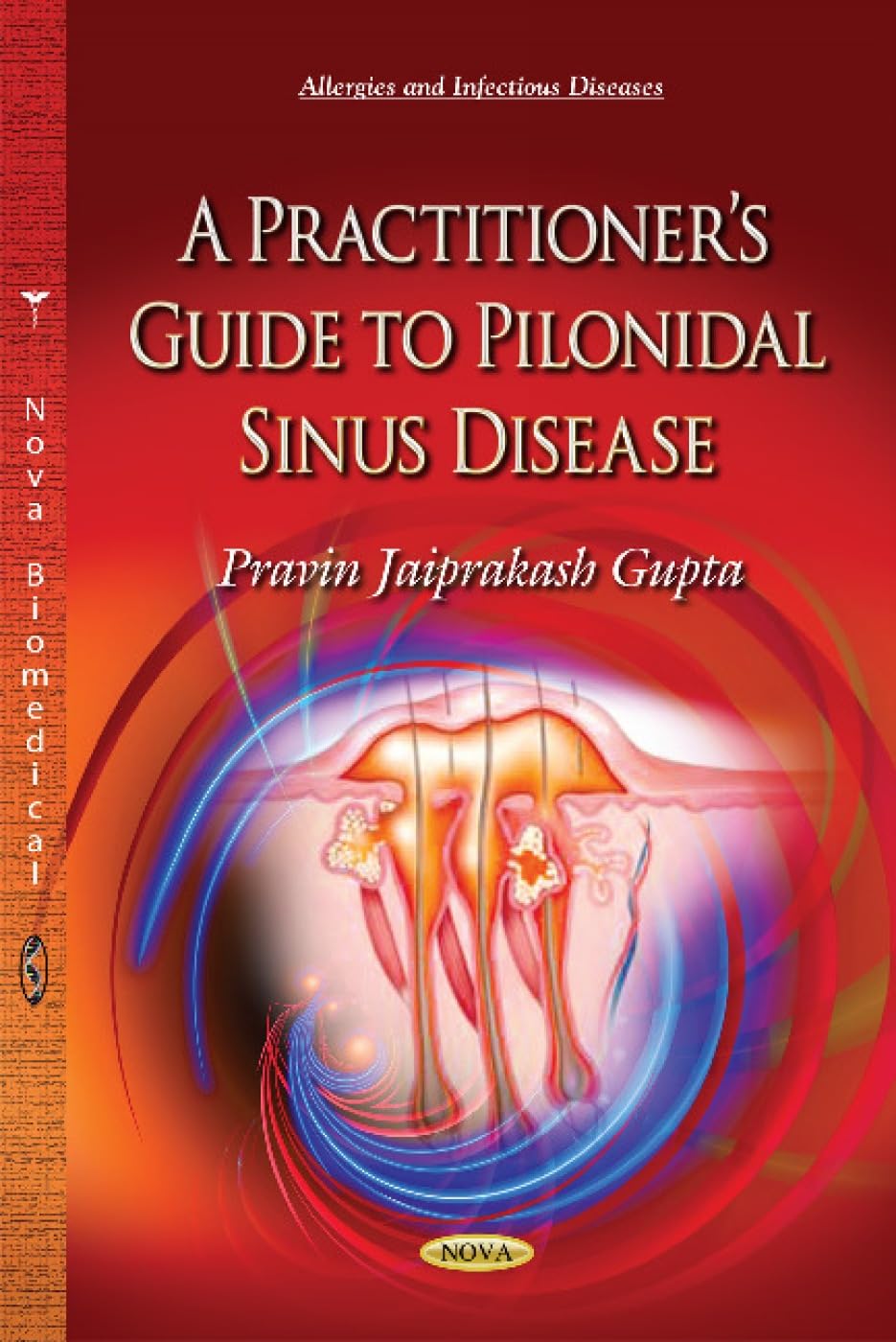 A Practitioner s Guide to Pilonidal Sinus Disease (Allergies and Infectious Disease)