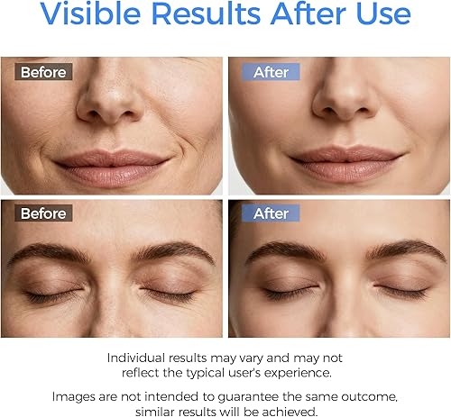 Miniatura 3 de Espátula facial para exfoliar la piel, herramienta removedor de puntos negros para limpieza profunda facial, limpiador de poros con 4 modos,